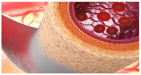 curățarea vaselor de sânge de colesterol cu ​​vene varicoase